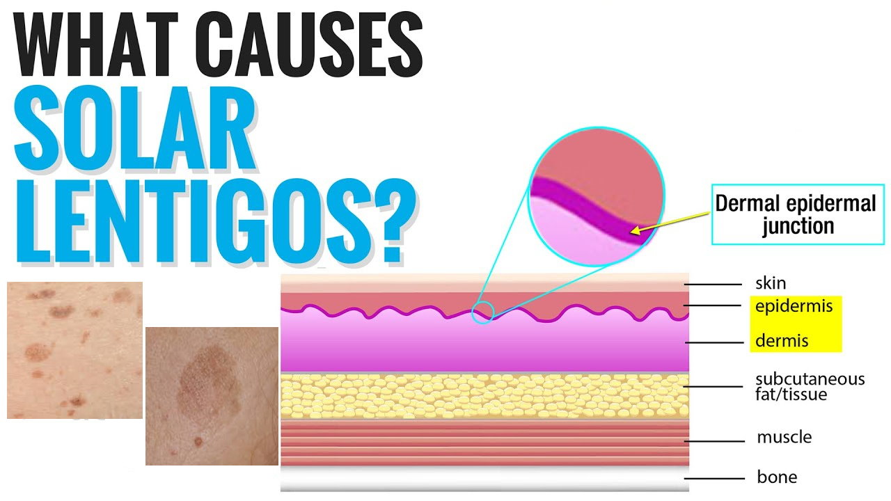 孚美达“氟轻松氢醌维A酸乳膏”能用于老年斑治疗吗？