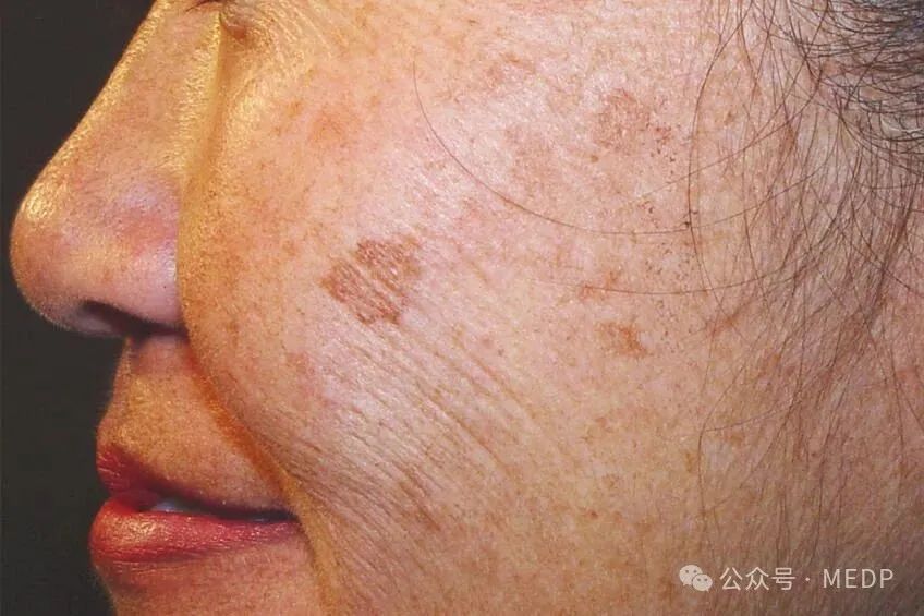 老年斑、晒斑、日光性雀斑是一回事吗？